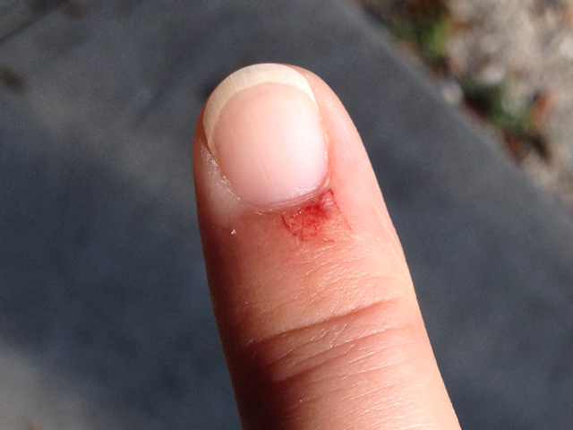 scratched finger